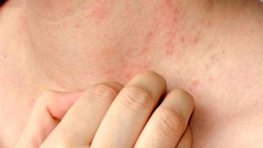 You are currently viewing Experts urge early treatment on lupus